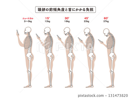 直頸(智慧型手機頸)頭部傾斜角度和頸部勞損 直頸(智慧型手機頸)頭部傾斜角度和頸部勞損 131473820