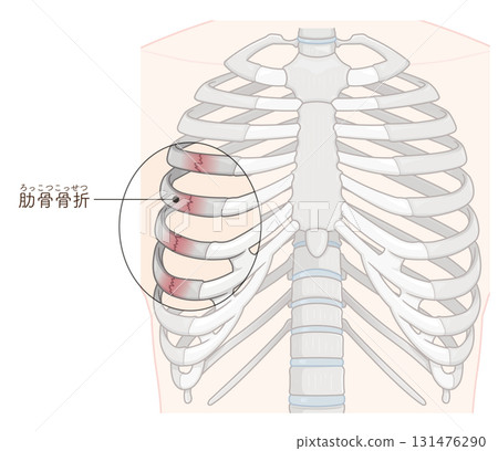 Broken rib illustration Broken rib illustration 131476290