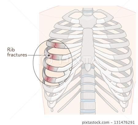 Broken rib illustration Broken rib illustration 131476291