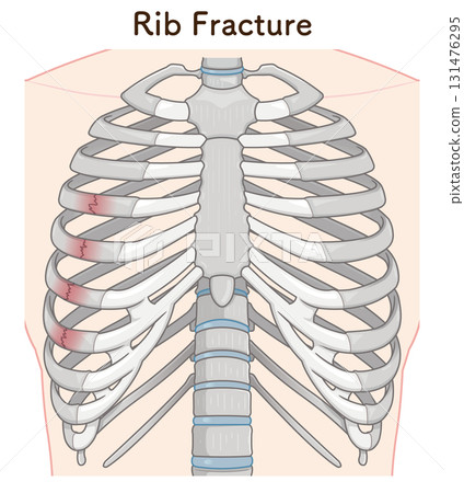 肋骨骨折圖 肋骨骨折圖 131476295