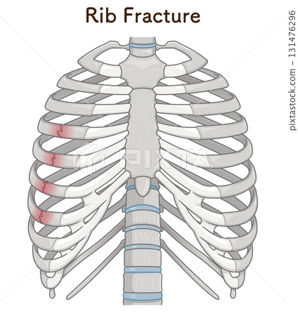 肋骨骨折圖 肋骨骨折圖 131476296