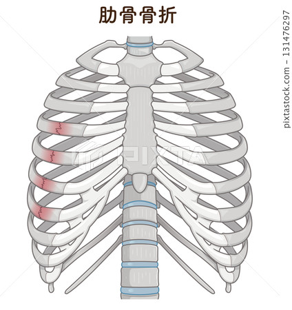 肋骨骨折圖 131476297