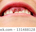 Front teeth where adult teeth are beginning to grow 131488128