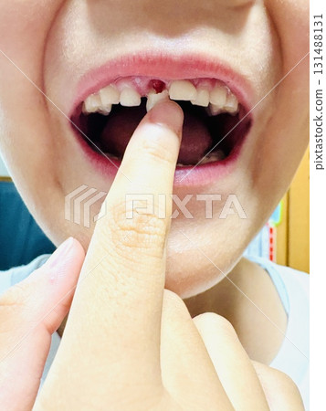 即將脫落的門牙 即將脫落的門牙 131488131