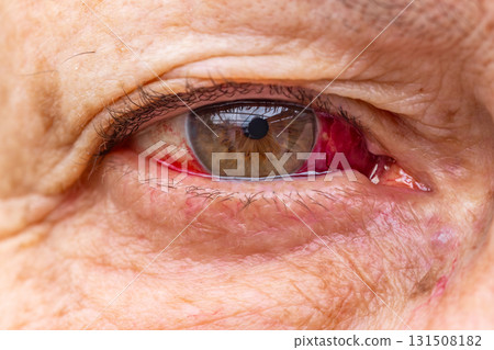 Elderly woman with eye injury and bleeding indoors during daytime 131508182