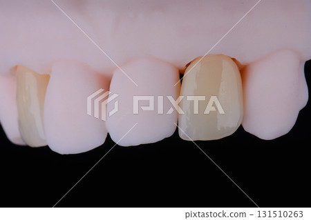High-quality dental single crowns made of zirconium for fixation to the frontal teeth of upper jaw. High-quality dental single crowns made of zirconium for fixation to the frontal teeth of upper jaw. 131510263