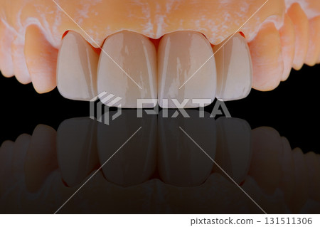 High-quality four dental crowns made of zirconium for fixation to the frontal teeth of upper jaw. High-quality four dental crowns made of zirconium for fixation to the frontal teeth of upper jaw. 131511306