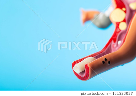 Antibacterial female suppository for restoring microflora in a medical model of the female reproductive system on a blue background. Copy space for text Antibacterial female suppository for restoring microflora in a medical model of the female reproductive system on a blue background. Copy space for text 131523037