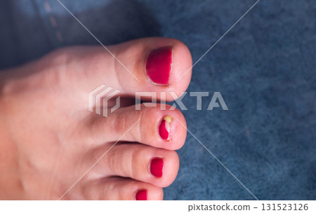 Close examination of toe with red nail polish during a pedicure session in a well-lit salon. A festering nail. Copy space for text Close examination of toe with red nail polish during a pedicure session in a well-lit salon. A festering nail. Copy space for text 131523126