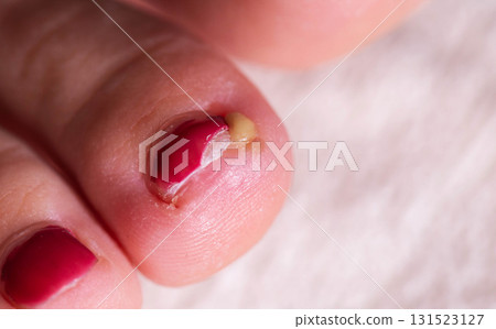 Healthy nail care tips for preventing ingrown toenails and promoting foot health 131523127