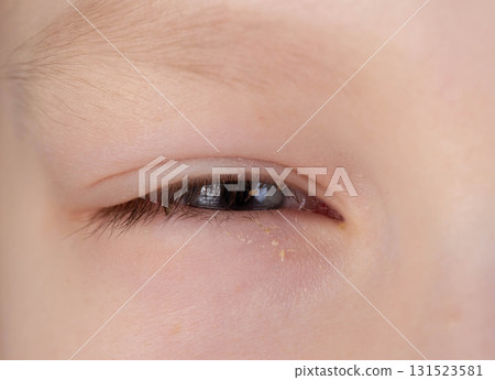 Painful red eye of a girl during a viral cold. Inflammation conjunctivitis, macro 131523581