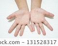 A child's hands and feet with a rash from hand, foot, and mouth disease (medical/infectious disease image) 131528317