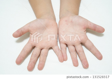 A child's hands and feet with a rash from hand, foot, and mouth disease (medical/infectious disease image) A child's hands and feet with a rash from hand, foot, and mouth disease (medical/infectious disease image) 131528317