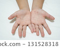 A child's hands and feet with a rash from hand, foot, and mouth disease (medical/infectious disease image) 131528318