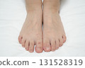 A child's hands and feet with a rash from hand, foot, and mouth disease (medical/infectious disease image) 131528319