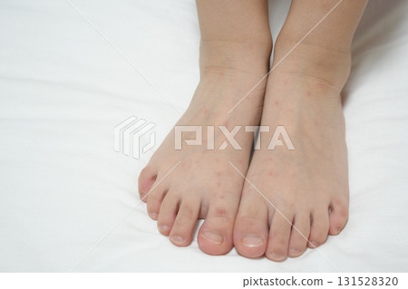 一名兒童的手腳因手足口病而出現皮疹（醫學/傳染病影像） 131528320