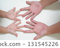 Hand, foot, and mouth disease rash seen in a parent and child (medical and infectious disease awareness image) 131545226