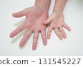 Hand, foot, and mouth disease rash seen in a parent and child (medical and infectious disease awareness image) 131545227