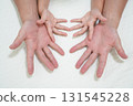 Hand, foot, and mouth disease rash seen in a parent and child (medical and infectious disease awareness image) 131545228