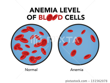 Anemia level of blood cells stock illustration 131562078