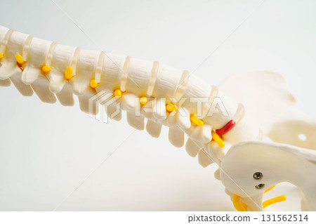 Spinal nerve and bone, Lumbar spine displaced herniated disc fragment, Model for treatment medical in the orthopedic department. 131562514