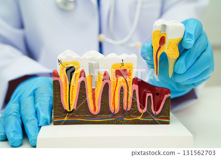 Dentist holding dental implant, artificial tooth roots into jaw, root canal of dental treatment, gum disease, teeth model for dentist. 131562703