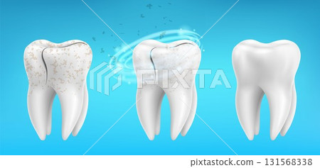 3d realistic clean and dirty tooth set on blue background, Teeth cleaning and whitening procedure. Dental health concept. Healthy enamel. Vector illustration. 3d realistic clean and dirty tooth set on blue background, Teeth cleaning and whitening procedure. Dental health concept. Healthy enamel. Vector illustration. 131568338