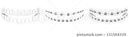 Teeth with or without braces. Arch braces without teeth. Orthodontic dentistry. The alignment of the teeth. Healthy lifestyle and dental care. Isolated realistic vector illustration Teeth with or without braces. Arch braces without teeth. Orthodontic dentistry. The alignment of the teeth. Healthy lifestyle and dental care. Isolated realistic vector illustration 131568339