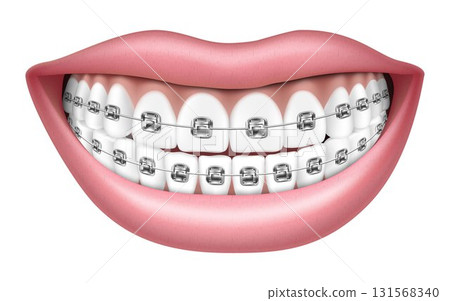Smile with white teeth and braces. Realistic 3D Vector illustration, isolated on white background, Smile with white teeth and braces. Realistic 3D Vector illustration, isolated on white background, 131568340