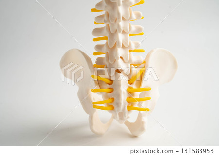 Spinal nerve and bone, Lumbar spine displaced herniated disc fragment, Model for treatment medical in the orthopedic department. Spinal nerve and bone, Lumbar spine displaced herniated disc fragment, Model for treatment medical in the orthopedic department. 131583953