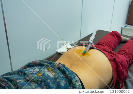 An intravertebral injection in female patient to treat pain from degenerative disc disease. 131600061