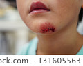 Injuried 131605563