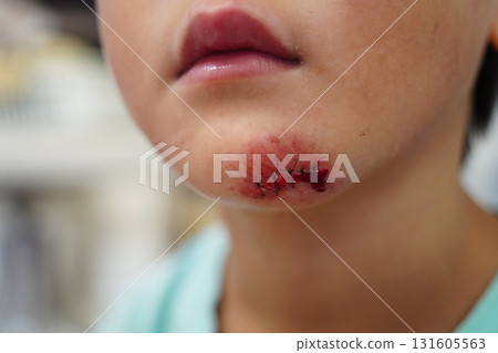 Injuried 131605563