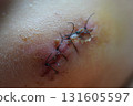 suture 131605597