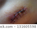 suture 131605598