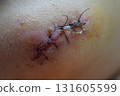 suture 131605599