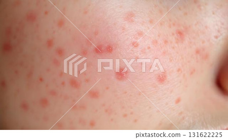 A woman with acne on her face, emphasizing skin health and dermatology, set against a simple background A woman with acne on her face, emphasizing skin health and dermatology, set against a simple background 131622225