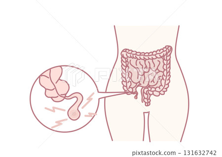 Human body with inflamed appendicitis 131632742