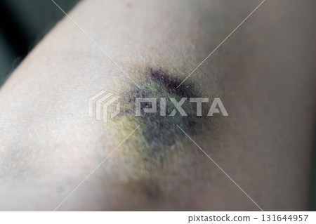 Bruise on arm after blood test, hematoma Bruise on arm after blood test, hematoma 131644957