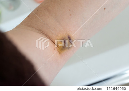 Bruise on arm after blood test, hematoma Bruise on arm after blood test, hematoma 131644960