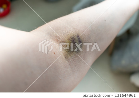 Bruise on arm after blood test, hematoma Bruise on arm after blood test, hematoma 131644961