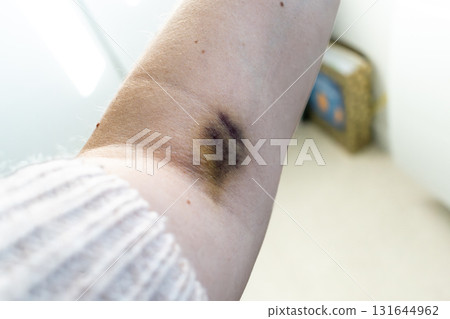 Bruise on arm after blood test, hematoma Bruise on arm after blood test, hematoma 131644962