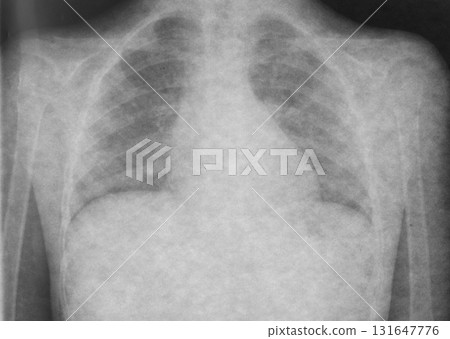 X-ray of the lungs of a sick child. Health examination for suspected bronchitis and pneumonia 131647776
