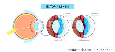 Ectopia lentis disease 131658642