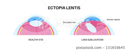 Ectopia lentis disease 131658645