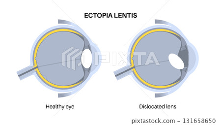 Ectopia lentis disease Ectopia lentis disease 131658650