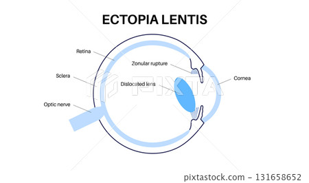 Ectopia lentis disease Ectopia lentis disease 131658652