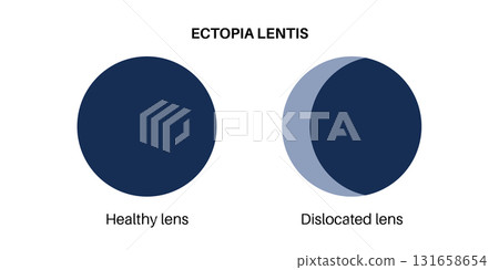 Ectopia lentis disease 131658654