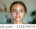 Transformation of skin clarity showcasing before and after treatment on a woman's face with noticeable changes in complexion and texture 131674419