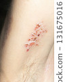 Woman with shingles on the skin she feels very painful 131675016
